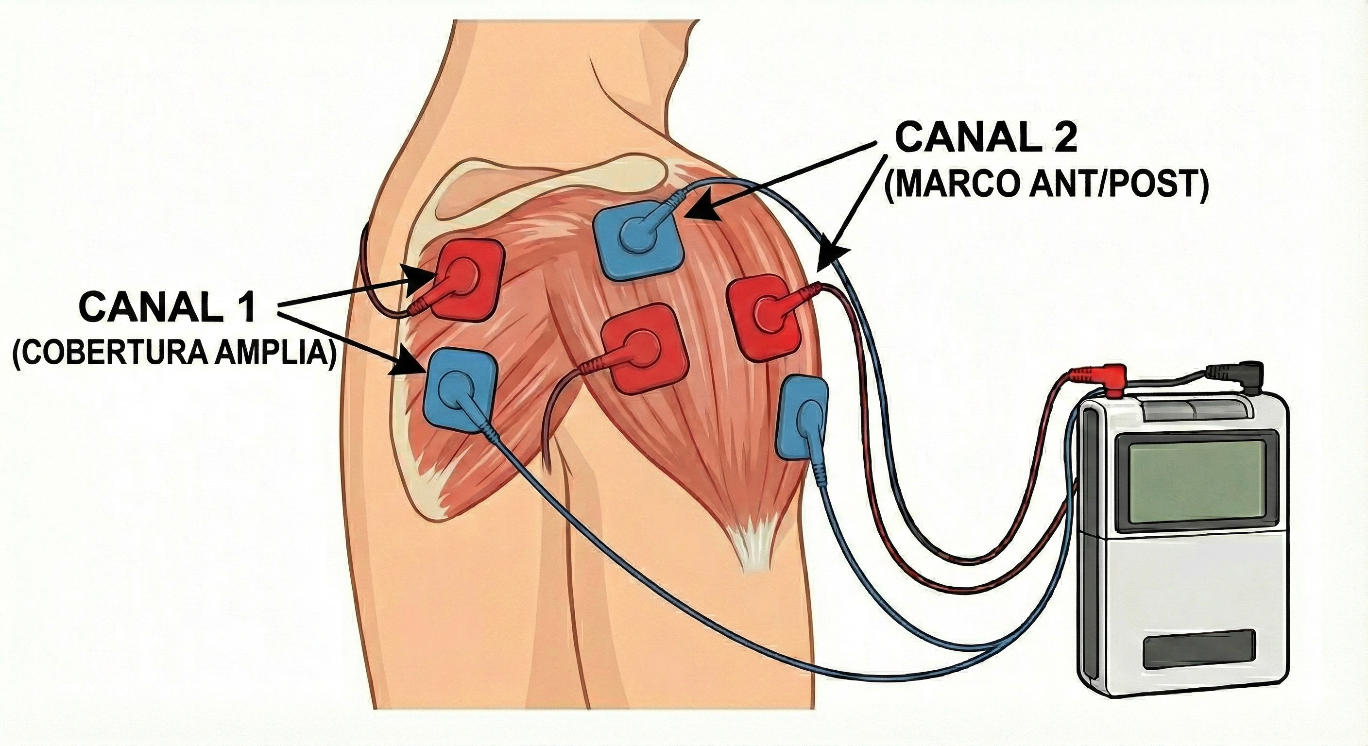 Colocación TENS en capsulitis adhesiva