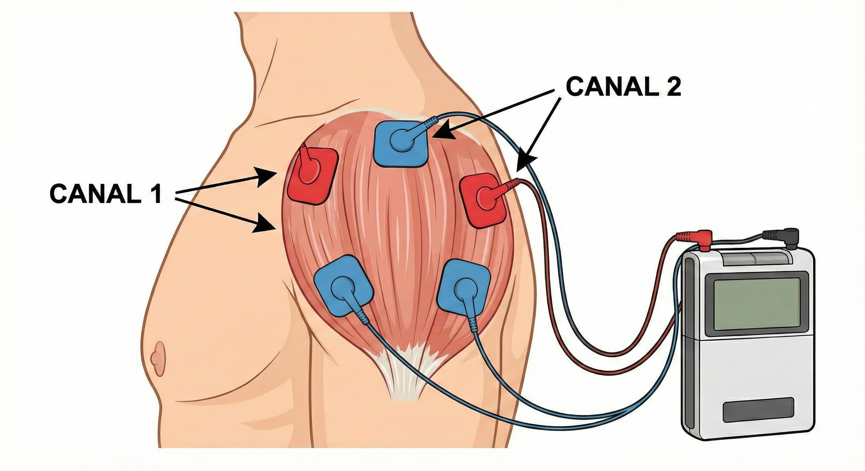 Colocación TENS en deltoides lateral