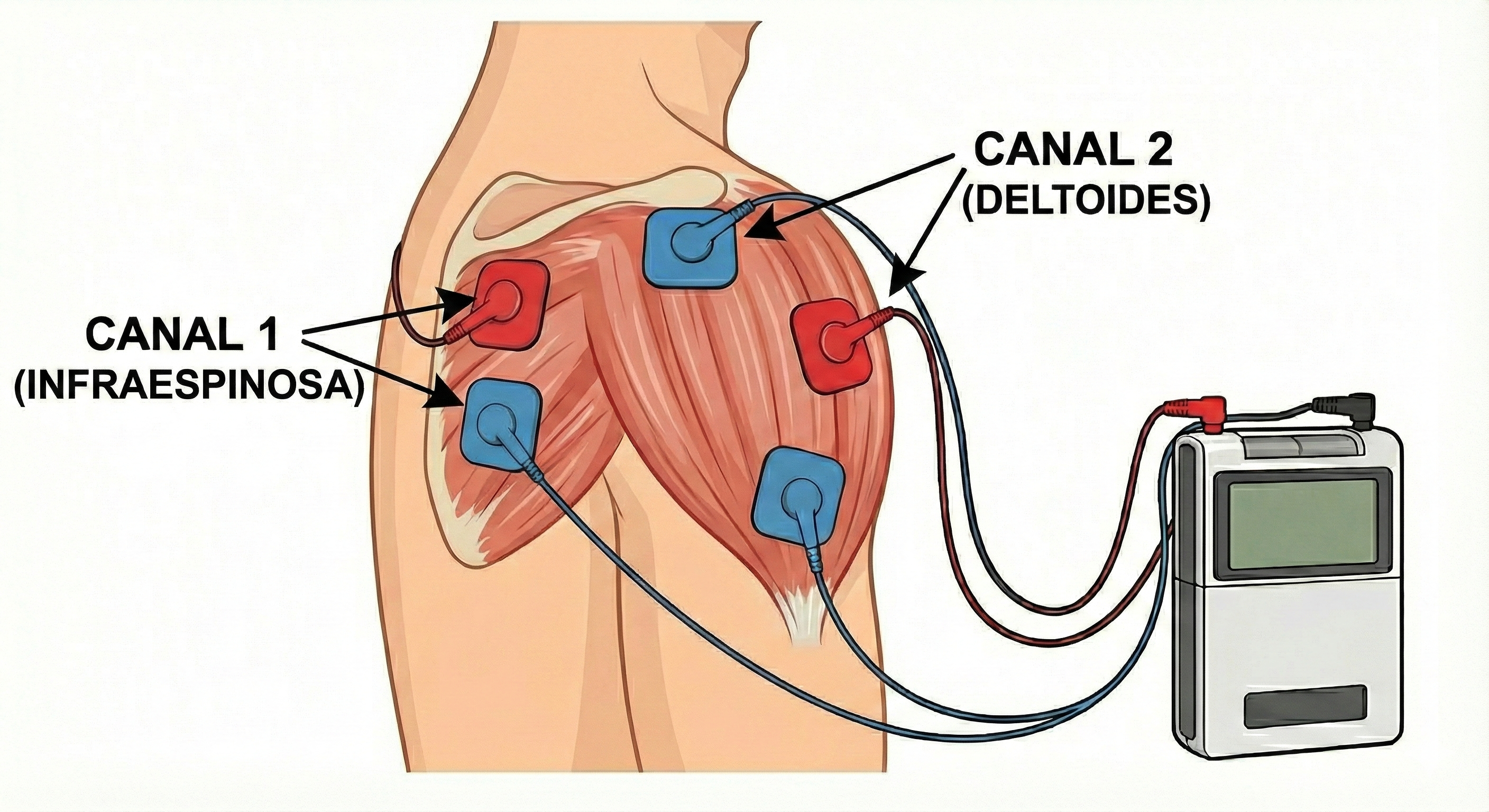 Colocación TENS en posterior/infraespinoso
