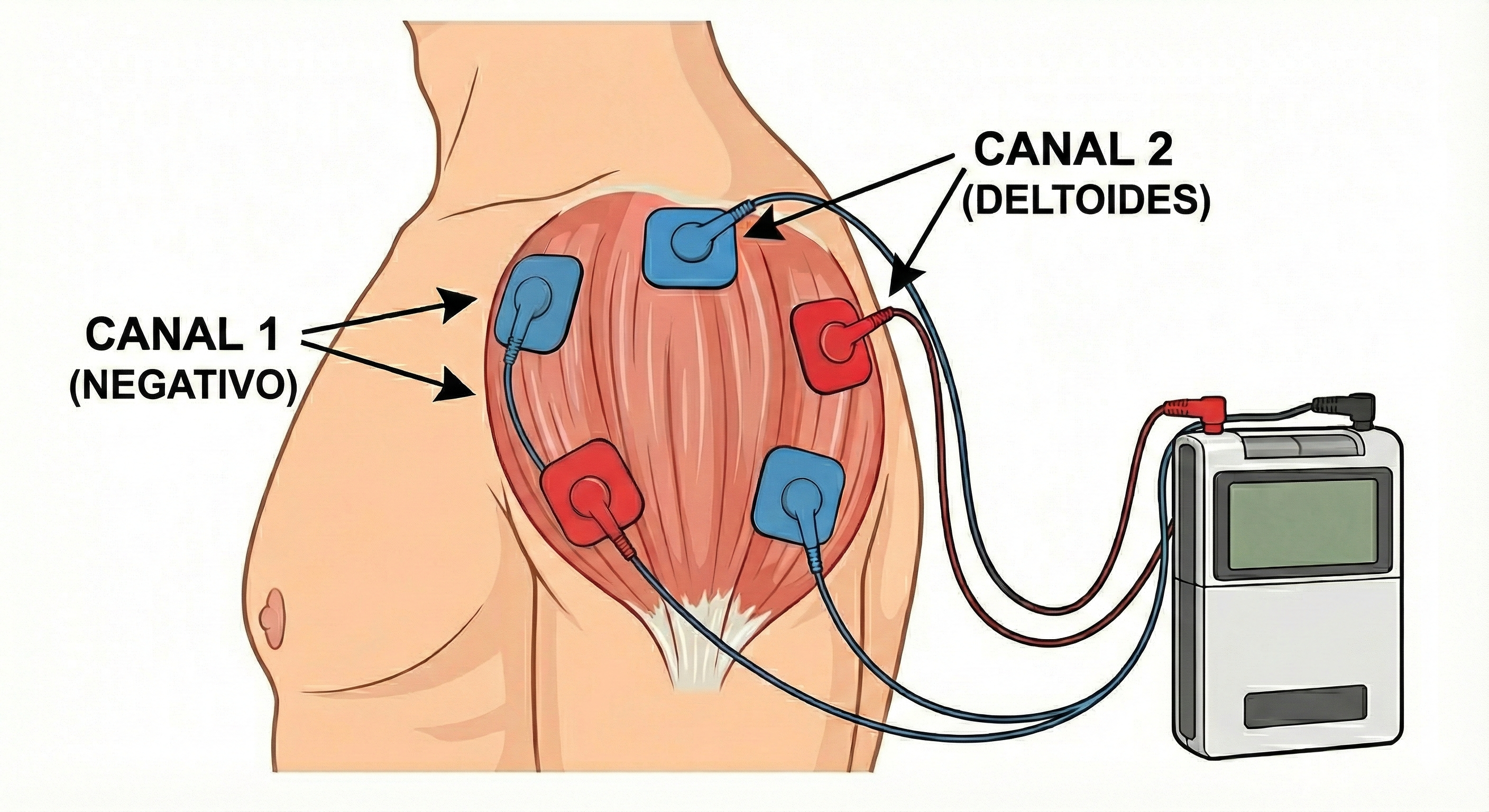 Colocación TENS en tendón largo del bíceps